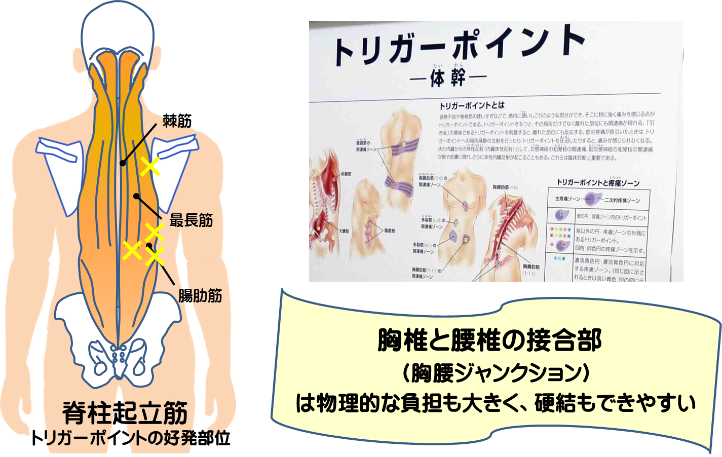 トリガーポイント　富士見台カイロプラクティックセンター