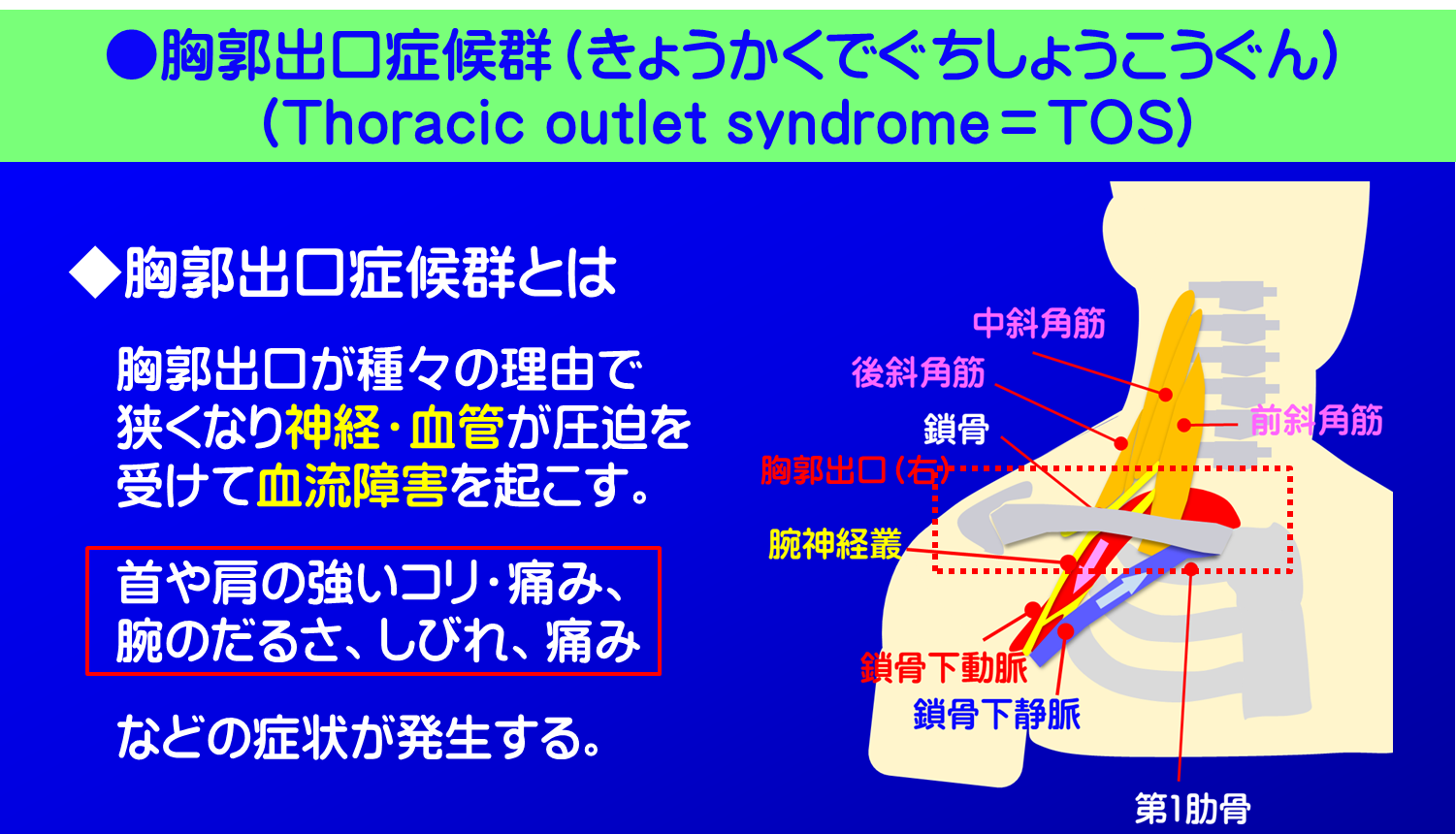 胸郭出口症候群/胸郭出口症候群とは