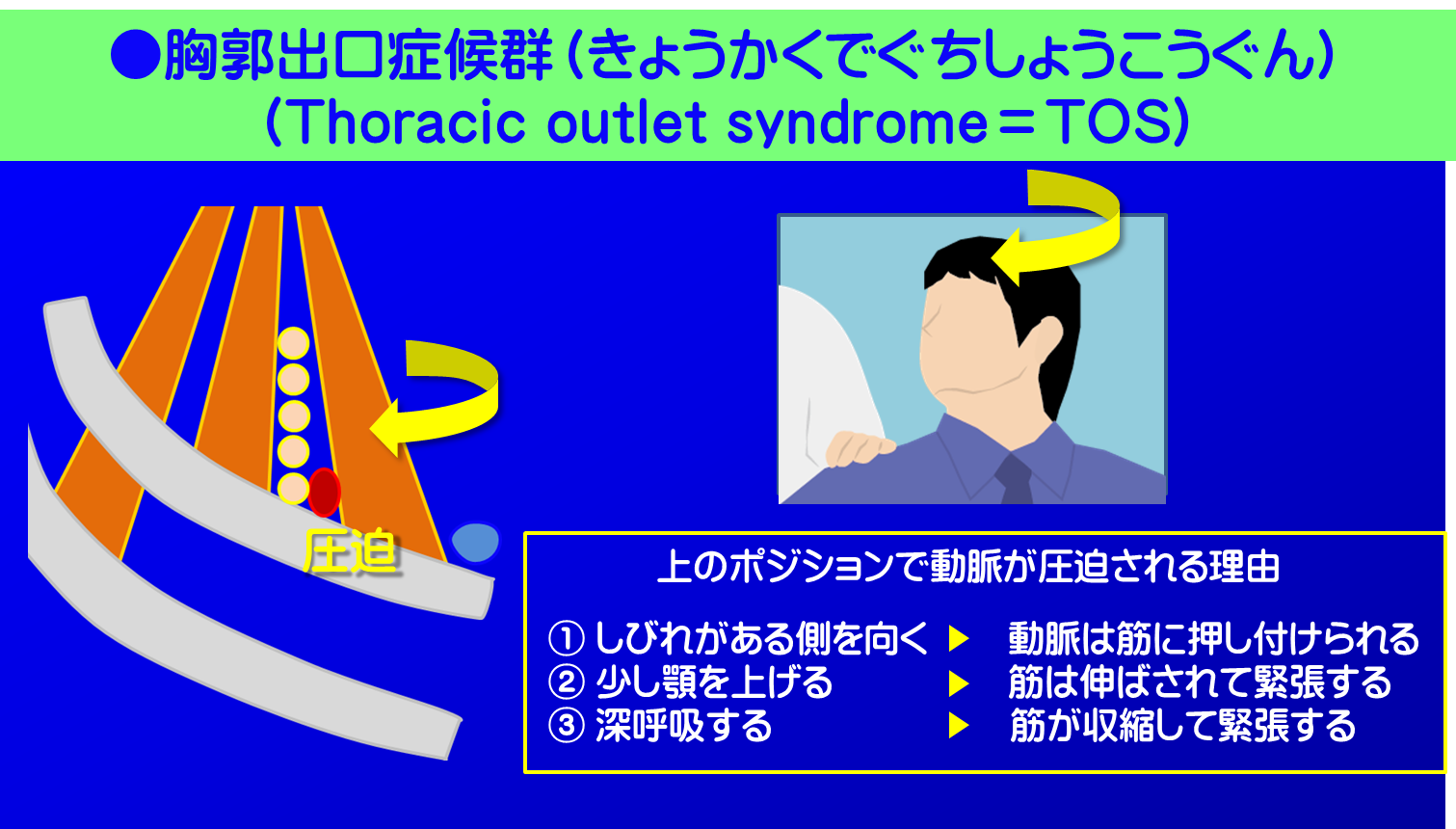 胸郭出口症候群/アドソンテスト