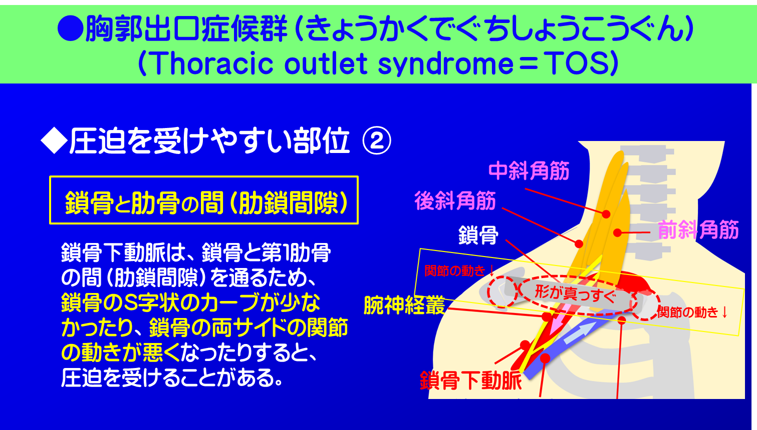 胸郭出口症候群／圧迫を受けやすい部位