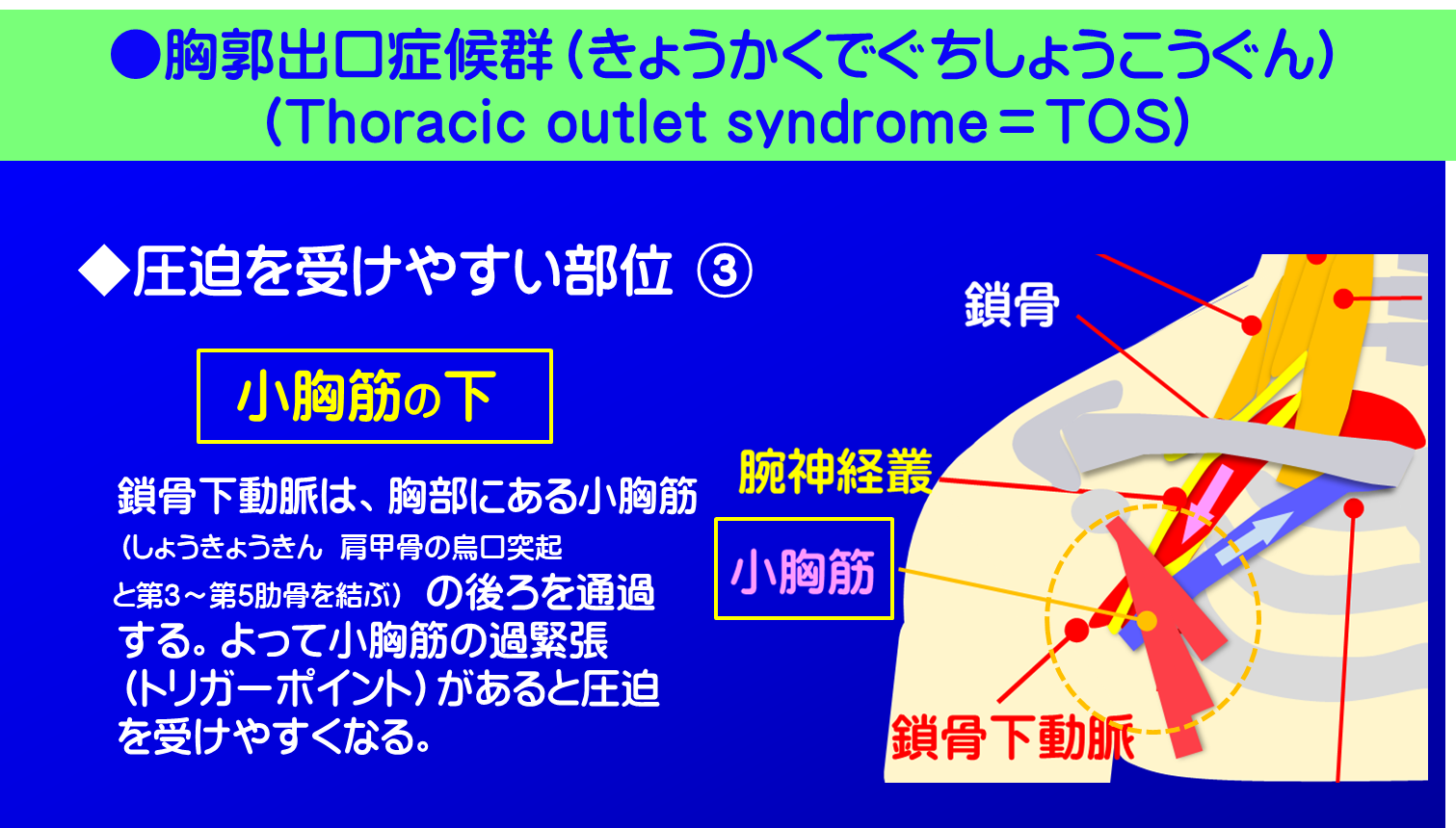 胸郭出口症候群／圧迫を受けやすい部位