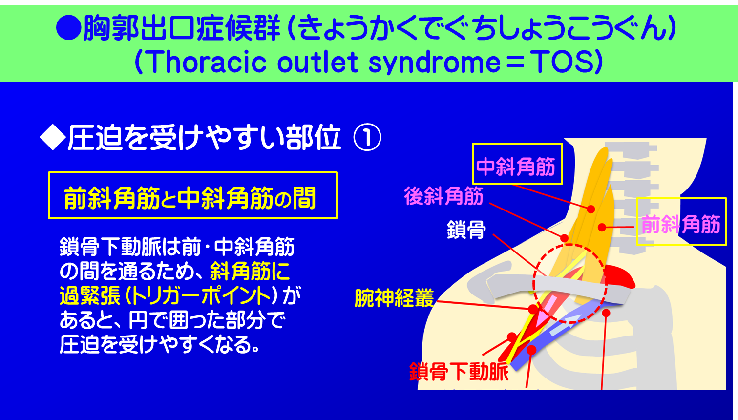 胸郭出口症候群/◆圧迫を受けやすい要因 ①