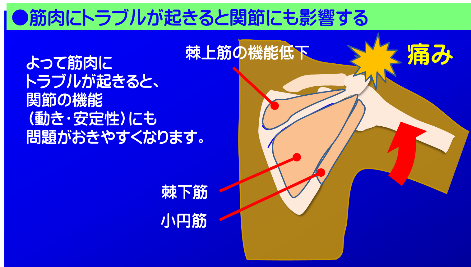 筋肉が原因の肩の痛み/富士見台カイロプラクティックセンター