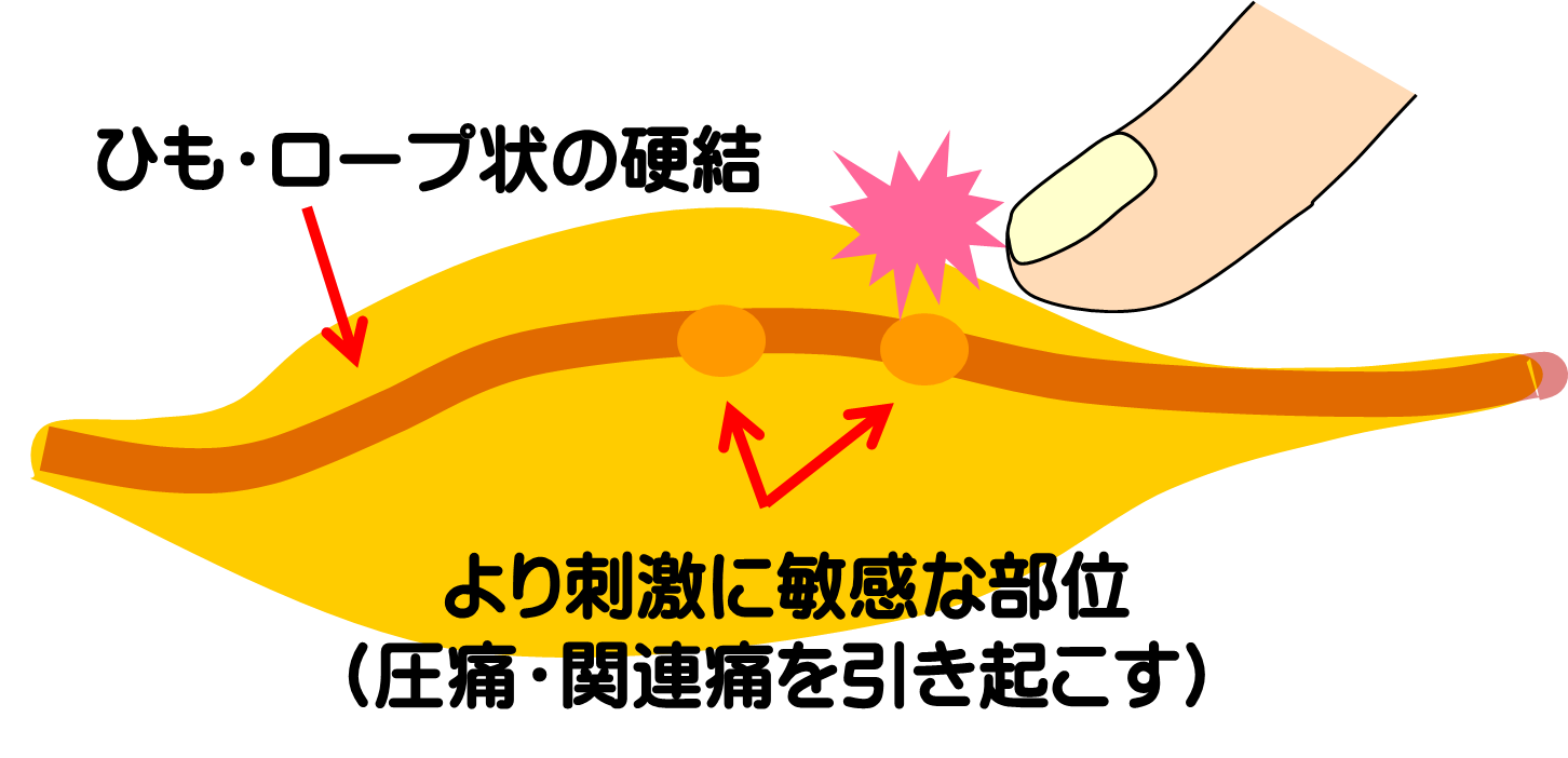 トリガーポイントの見つけ方／富士見台カイロプラクティックセンター