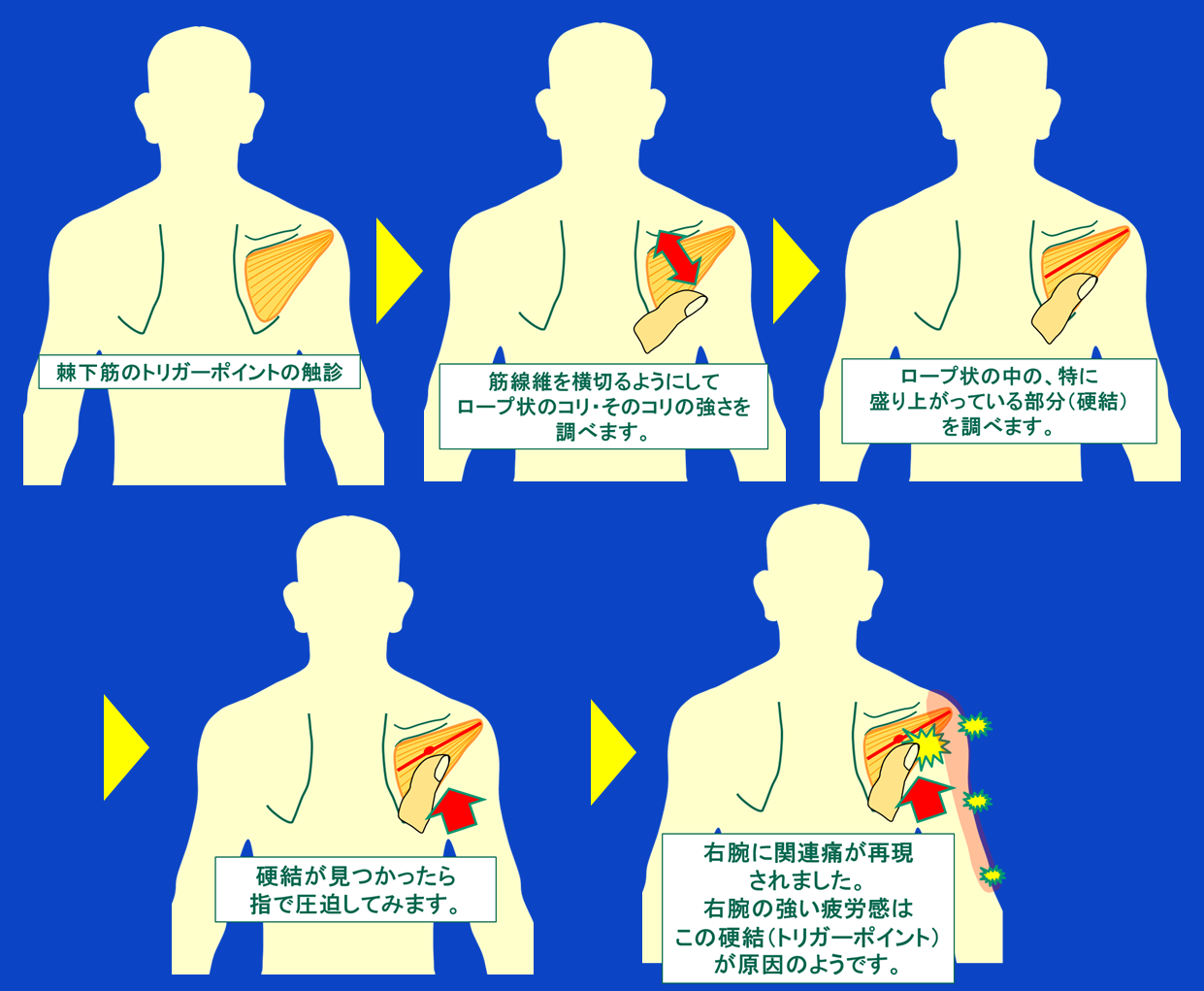 トリガーポイントの見つけ方／肩の痛みの原因となりやすい棘下筋／富士見台カイロプラクティックセンター