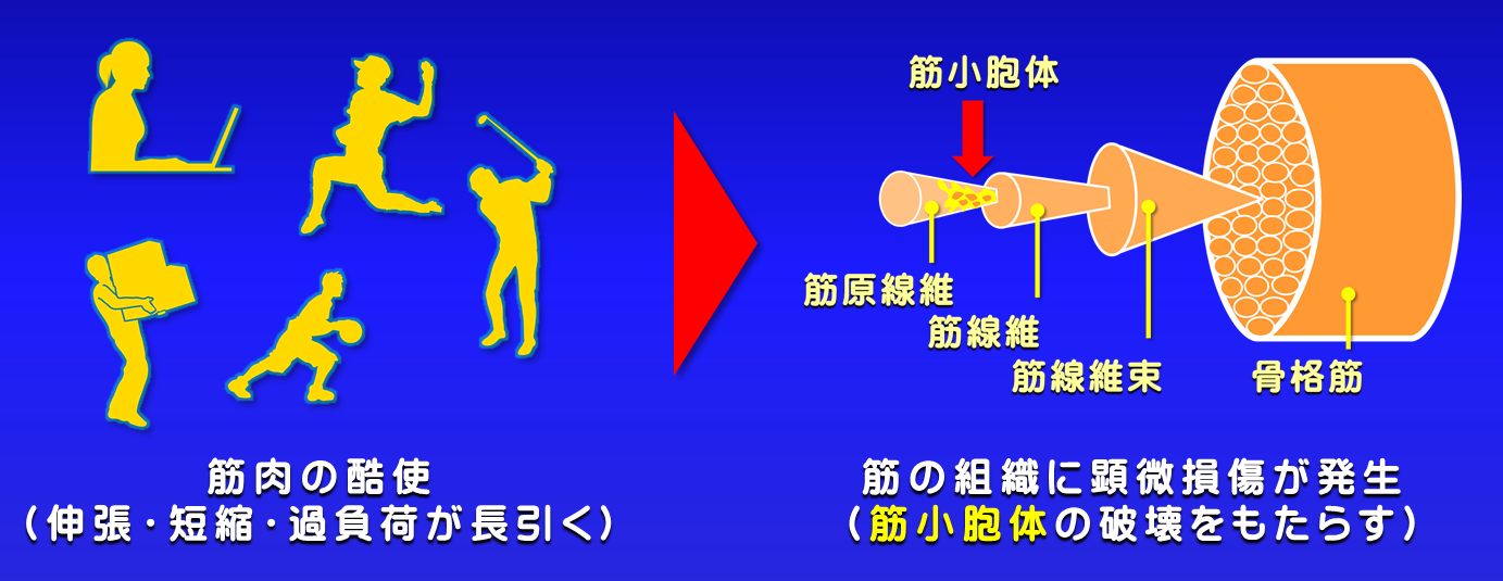 トリガーポイントができるしくみ／富士見台カイロプラクティックセンター