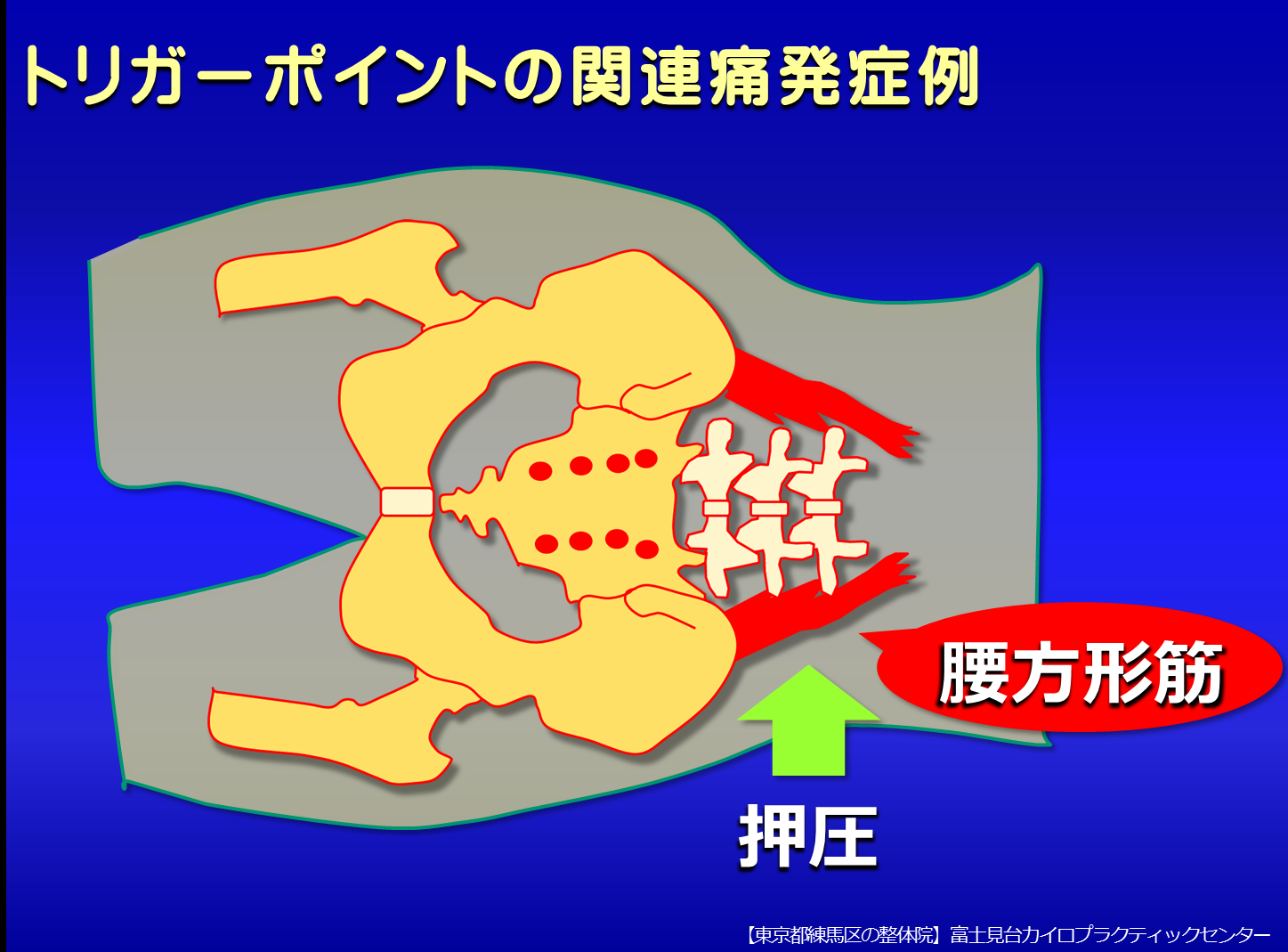 トリガーポイントの関連痛発症例／腰痛・お尻の痛み／富士見台カイロプラクティックセンター