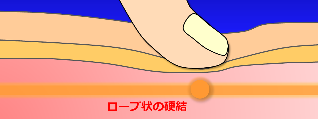 トリガーポイント・ロープ状の硬結／富士見台カイロプラクティックセンター