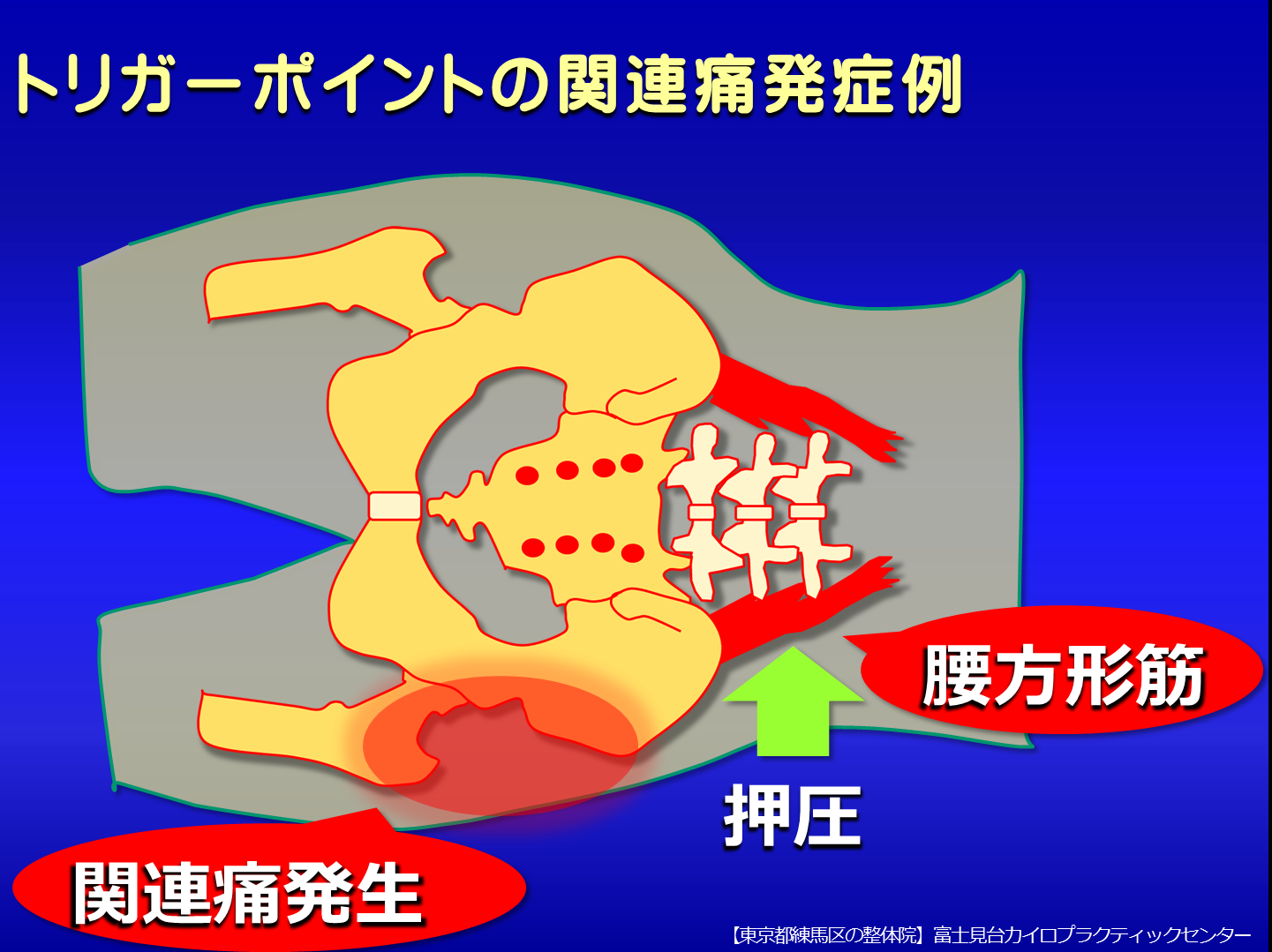 トリガーポイントの関連痛発症例／腰痛・お尻の痛み／富士見台カイロプラクティックセンター